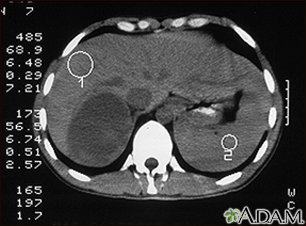 Tumor suprarenal - TC - Miniatura de ilustración
              