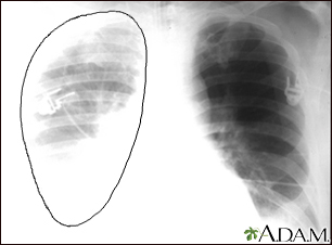 Ruptura aórtica - radiografía de tórax