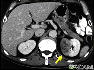 TC - tumor del riñón - Miniatura de ilustración
              