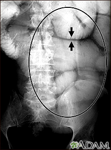 Ileo - Radiografía de la distensión intestinal - Miniatura de ilustración
              
