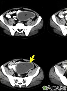 Absceso intraabdominal - TC