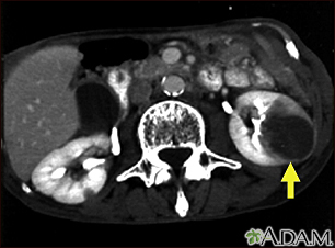 Metástasis del riñón - TC - Miniatura de ilustración
              