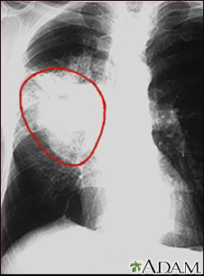 Cáncer de pulmón - radiografía frontal del tórax - Miniatura de ilustración
              