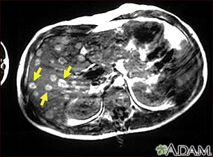 IRM del melanoma del hígado - Miniatura de ilustración
              