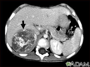 Tomografía computarizada de neuroblastoma en el hígado