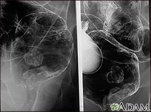Rayos X - de un cáncer rectal - Miniatura de ilustración
              
