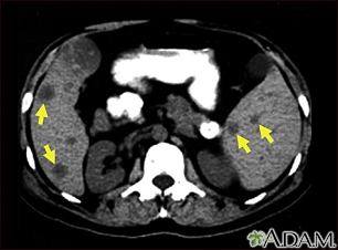 Metástasis en el bazo y el hígado – escaneo por TC - Miniatura de ilustración
              