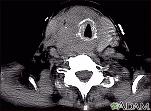 Tomografía computarizada de cáncer de tiroides - Miniatura de ilustración
              