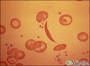 Glóbulos rojos drepanocíticos - Miniatura de ilustración
              