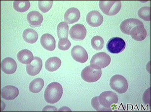 Anemia megaloblástica - Vista de los glóbulos rojos sanguíneos - Miniatura de ilustración
              