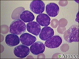 Microfotografía de leucemia linfocítica aguda