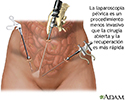 La laparoscopia pélvica