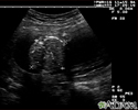 Ultrasonido de un feto normal - medidas del abdomen