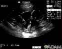 Ultrasonido de un feto normal - brazos y piernas