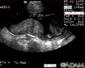 Ultrasonido, placenta normal - Braxton Hicks