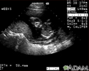 Ultrasonido de un feto normal - cara