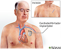 Cardiodesfibrilador implantable