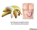 Bananas y náuseas