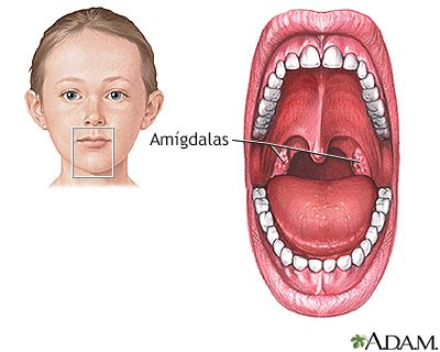 Amigdalectomía - Serie - Miniatura de presentación
              
