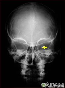 Neurofibromatosis I - agrandamiento de la abertura óptica - Miniatura de ilustración
              