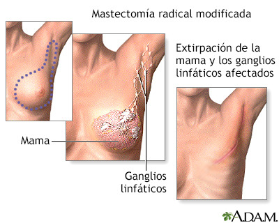 Mastectomía - Procedimiento (segunda parte)