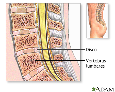 Injerto de hueso de la columna vertebral - serie