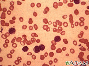 Leucemia linfocítica crónica - vista microscópica