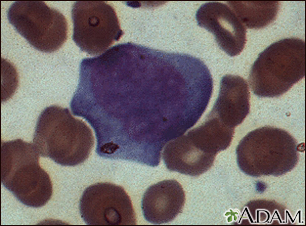 Mononucleosis - microfotografía de células - Miniatura de ilustración
              