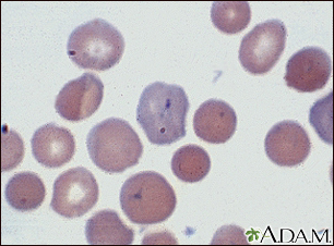 Malaria, vista microscópica de parásitos celulares - Miniatura de ilustración
              