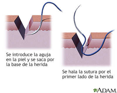 Cómo cerrar una herida por sutura (segunda parte)