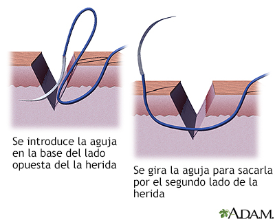 Clínica Hispana Airline - Tipos de sutura. Steri-strip: puntos de  aproximación ó puntos americanos. Son trozos longitudinales de esparadrapo  que mantienen juntos los bordes de una herida. Suturas de hilo. Por medio