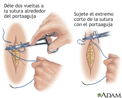 Clínica Hispana Airline - Tipos de sutura. Steri-strip: puntos de  aproximación ó puntos americanos. Son trozos longitudinales de esparadrapo  que mantienen juntos los bordes de una herida. Suturas de hilo. Por medio