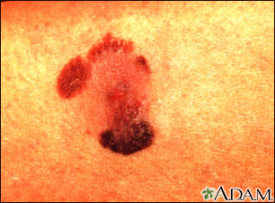 Cáncer de piel - melanoma maligno - Miniatura de ilustración
              