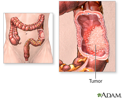 Cancer de colon en la etapa 4, Cancer de colon etapa 4, Stadiile cancerului de colon