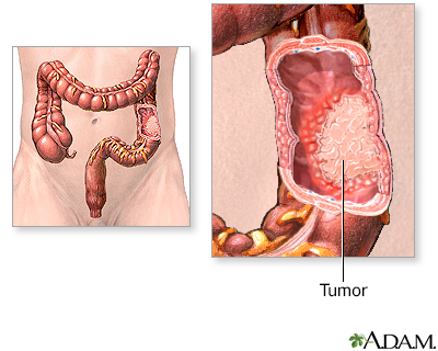 cancer de colon e higado