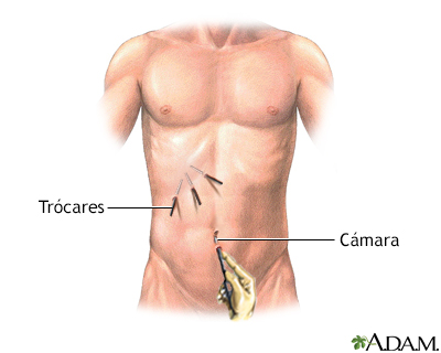 Cirugía laparoscópica - serie - Incisión