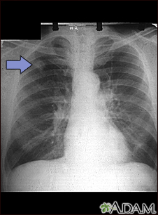Adenocarcinoma - placa de rayos x de tórax - Miniatura de ilustración
              