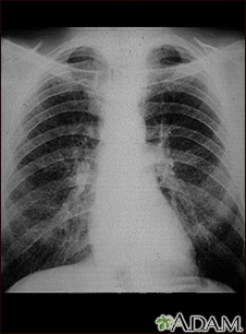 Pulmones de un trabajador del carbon -  radiografía de tórax - Miniatura de ilustración
              