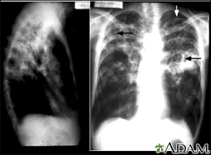 Tuberculosis, avanzada - radiografía de tórax - Miniatura de ilustración
              