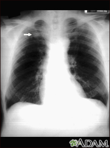 Nódulo pulmonary - vista frontal en placa de rayos x de tórax - Miniatura de ilustración
              