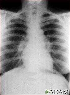 Sarcoidosis, estado I - radiografía de tórax - Miniatura de ilustración
              
