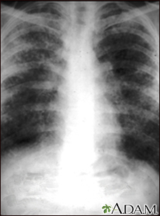 Sarcoidosis, estado II - radiografía de tórax - Miniatura de ilustración
              