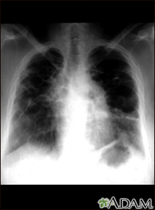 Sarcoide, etapa IV - rayos x de tórax