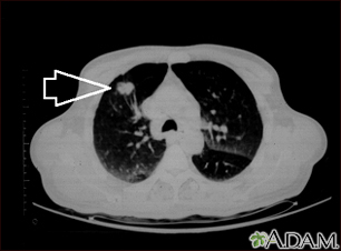 Masa pulmonar, lóbulo superior derecho - Tomografía computarizada - Miniatura de ilustración
              