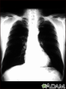 Cáncer bronquial - radiografía de tórax - Miniatura de ilustración
              