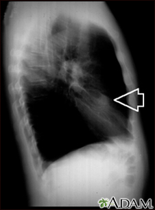 Nódulo pulmonar, lóbulo medio derecho - Radiografía de tórax - Miniatura de ilustración
              