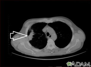 Masa pulmonar, pulmón derecho - Tomografía