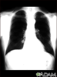 Nódulo pulmonar - Vista frontal de la radiografía de tórax - Miniatura de ilustración
              