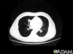 Nódulo pulmonar, pulmón inferior derecho - Tomografía computarizada - Miniatura de ilustración
              