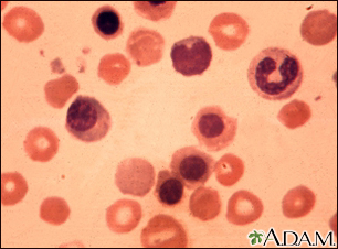 Eritroblastosis fetal - foto micrografía - Miniatura de ilustración
              